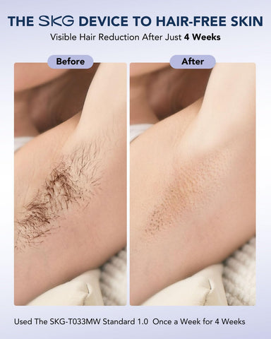 SKG Laser Hair Removal Device