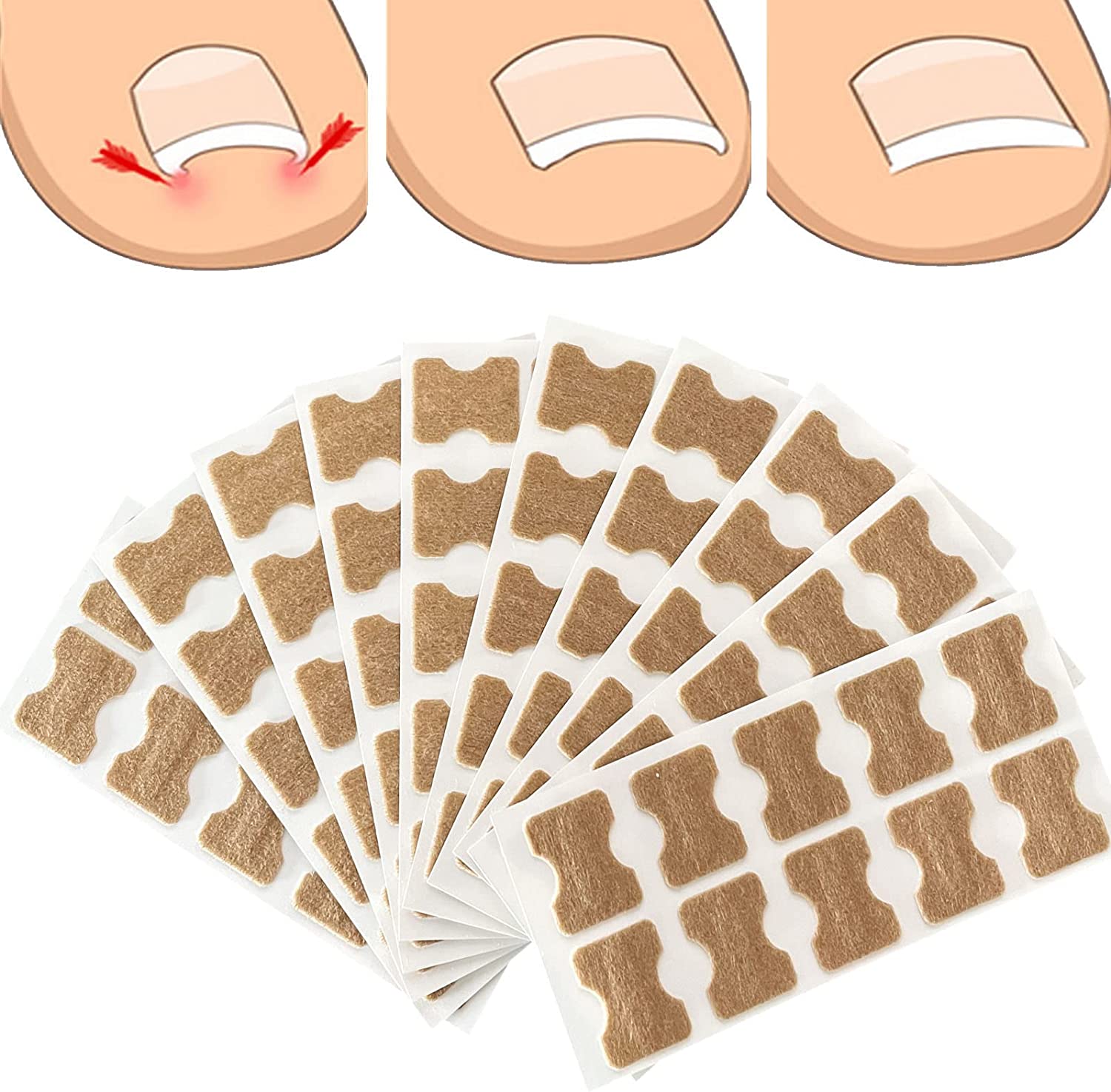 Sticker Corrector 100PCS Toenail Corrector Patch,Ingrown Toe Nail Correction Sticker ...