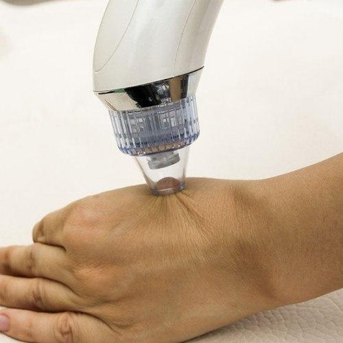 XN-8030 Facial Blackhead Cleanser Vacuum Suction